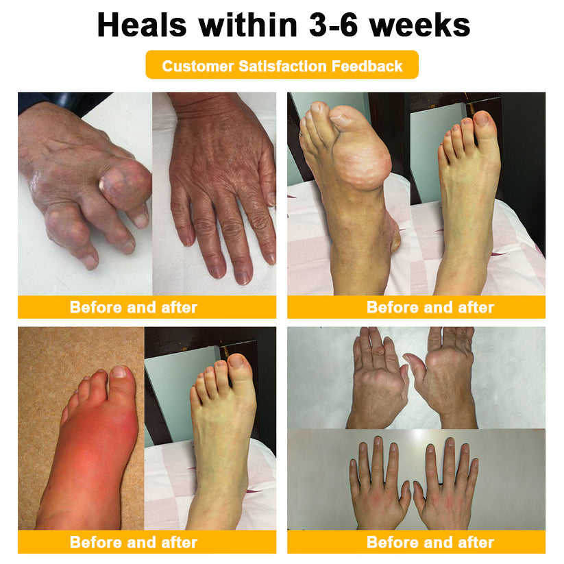 ADNOON® Botulinum Toxin & Bee Venom Pain-Relief Bone Healing Cream(Specially for older adults)